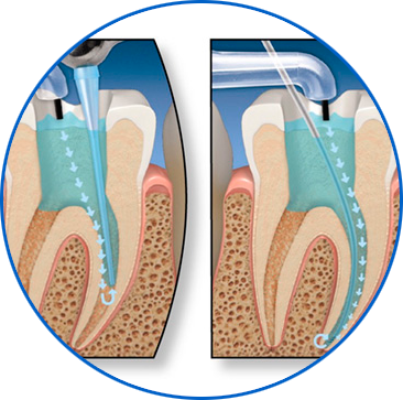 endodoncia