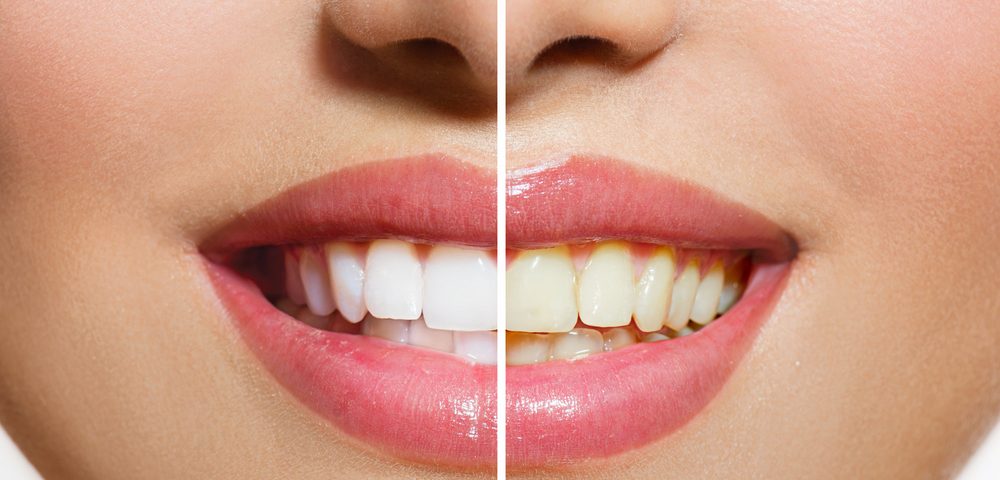 Dientes blancos: consejos para tener unos dientes más blancos