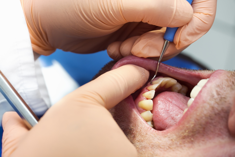 todo sobre la periodontitis